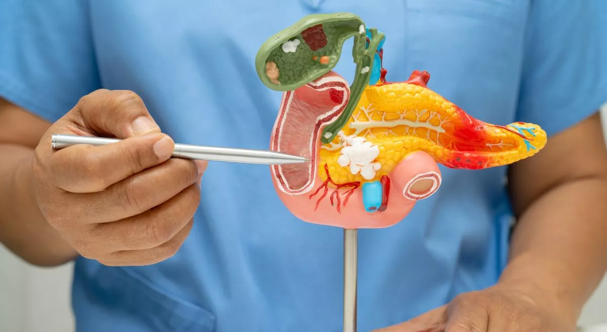 Understanding Pancreatic Cancer: Causes, Symptoms, Diagnosis, and Treatment