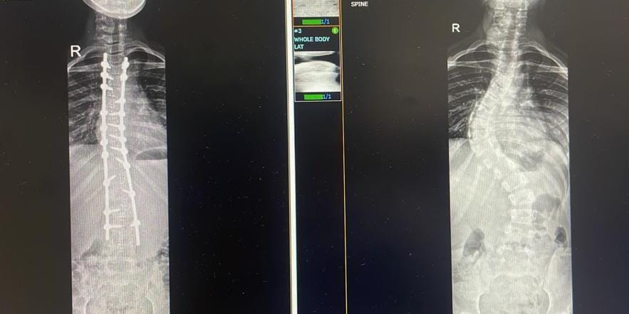 Scoliosis