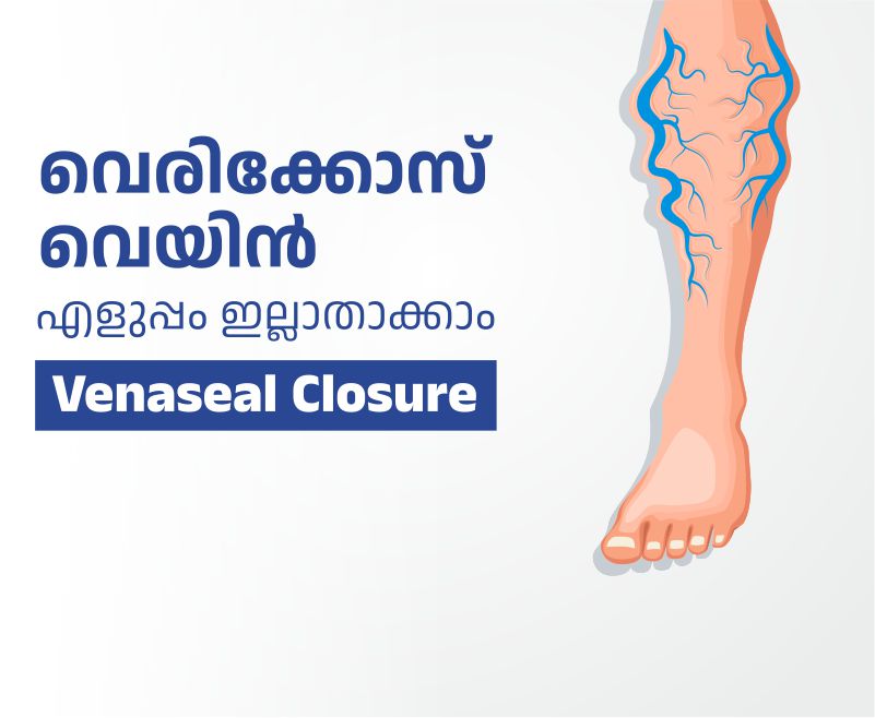 varicose veins