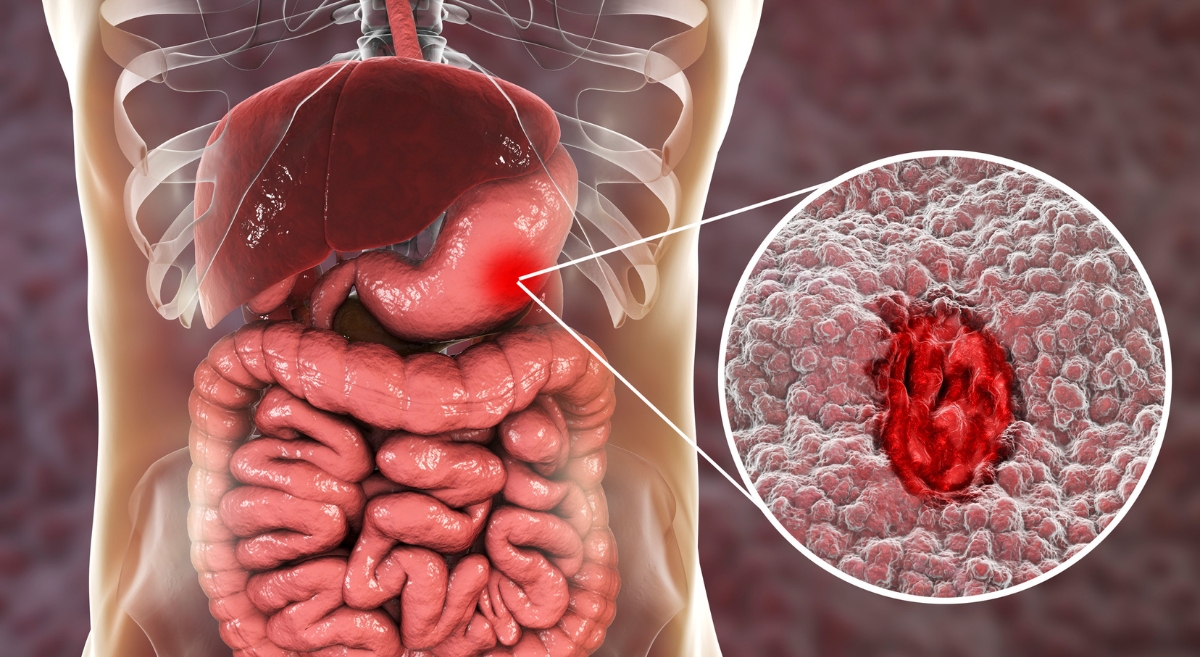 Gastrointestinal Stromal Tumor (GIST) Awareness Day: A Spotlight on Aster CMI Hospital’s Medical Gastroenterology Team