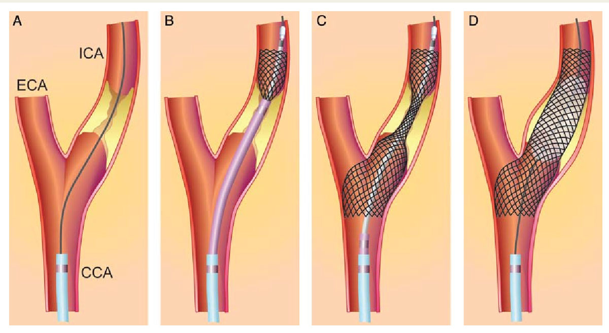 carotid