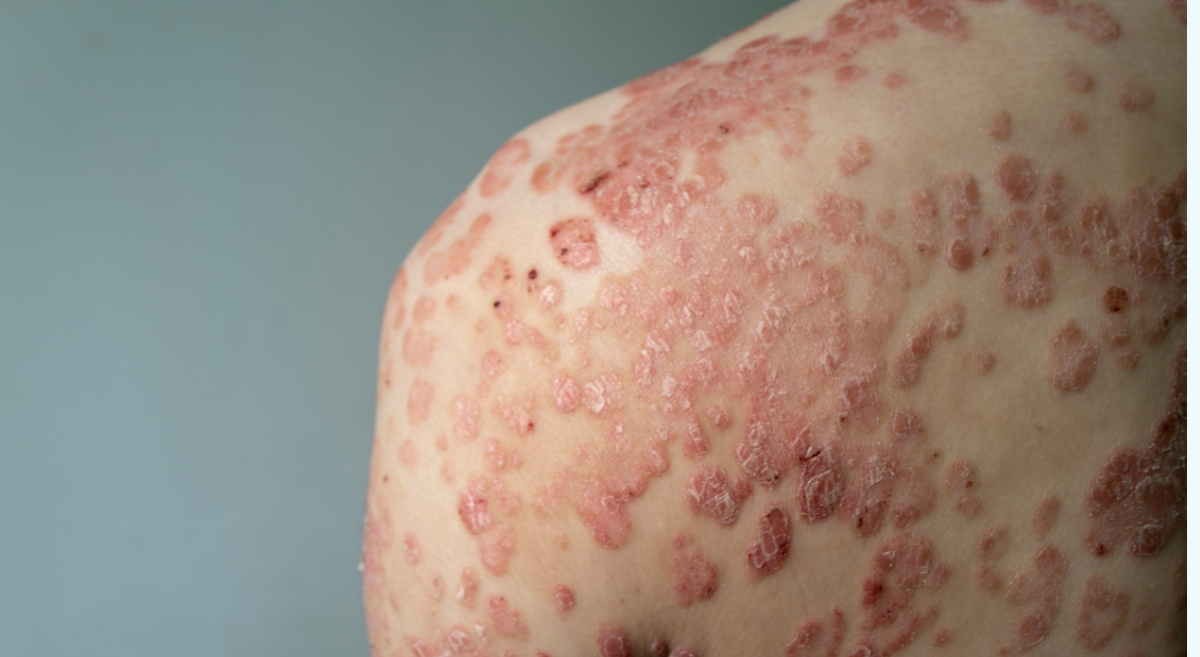 Understanding Psoriasis: A Chronic Skin Condition