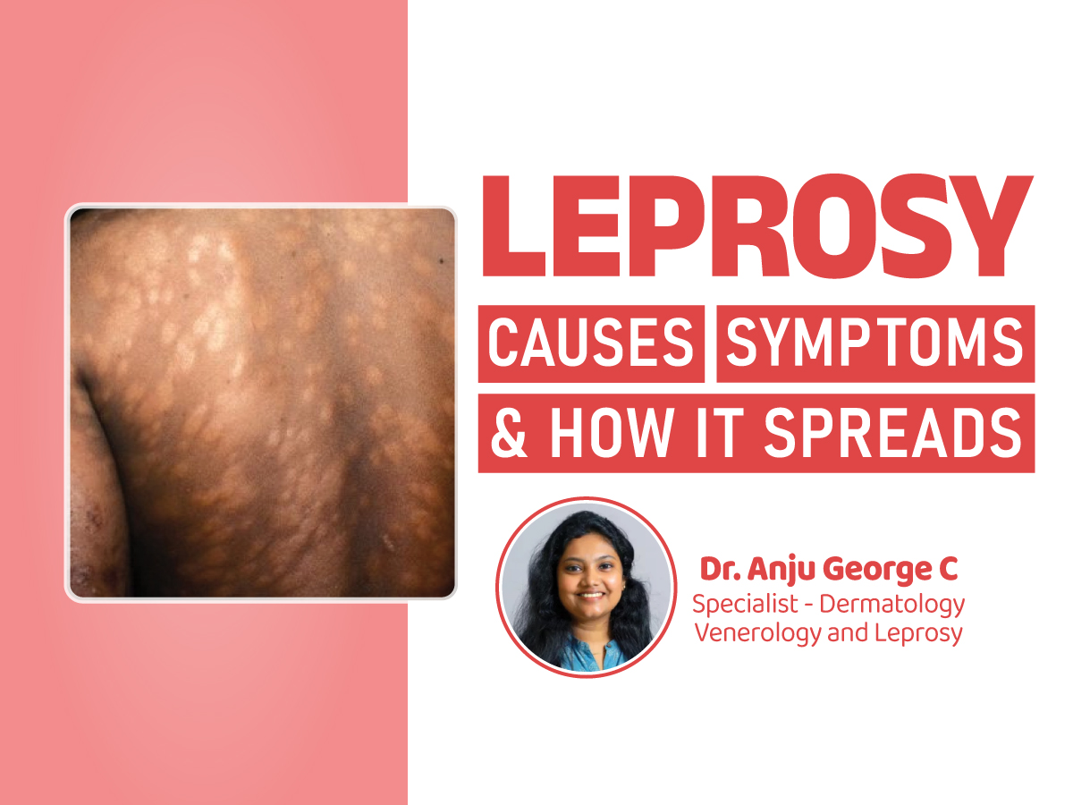 Understanding Leprosy: Causes, Symptoms, and How It Spreads