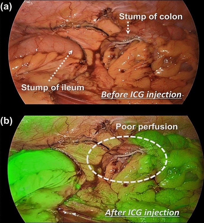 Picture depicting the use of ICG for laparoscopic identification of Sentinel node in endometrial cancer. 