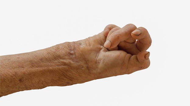 Leprosy Is Curable, The Real Challenge Is Stigma