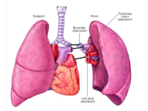 Single lung transplant