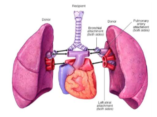 Double lung transplant