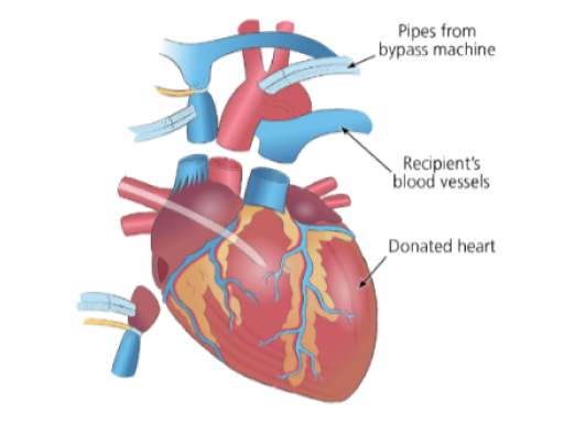 Heart-lung transplant