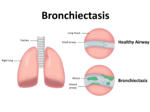 Bronchiectasis