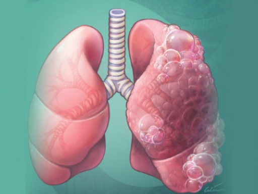 Chronic obstructive pulmonary disease