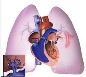 Congenital Heart Disease (CHD) with Severe Pulmonary Hypertension