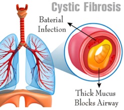 Cystic lung diseases