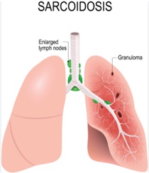 Sarcoidosis