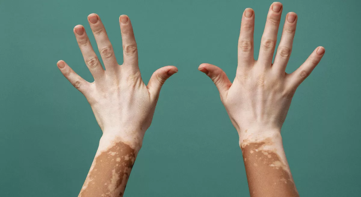 Vitiligo