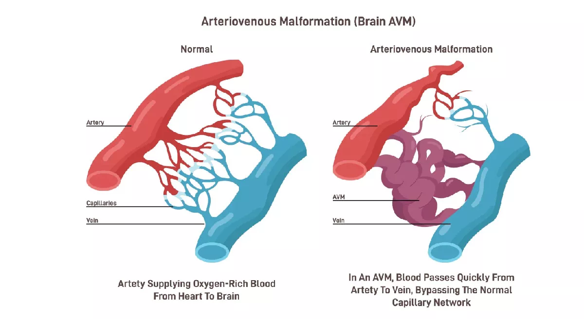 arteriovenous