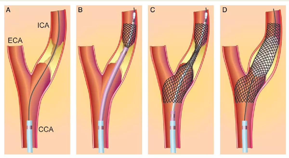 carotid