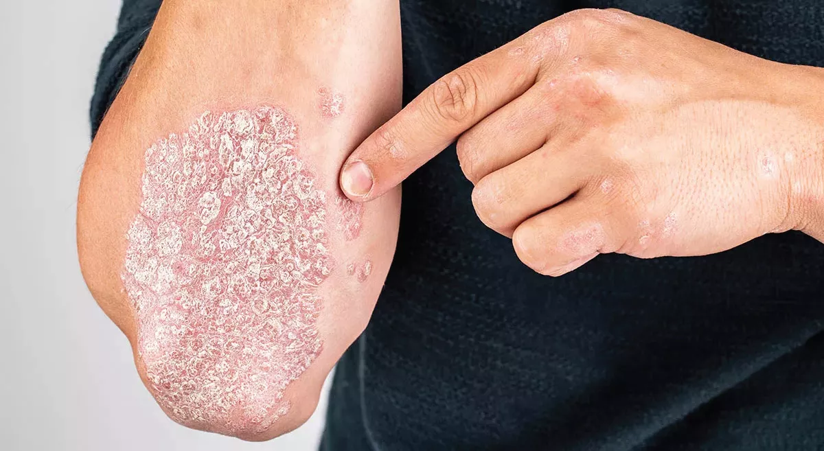 psoriasis