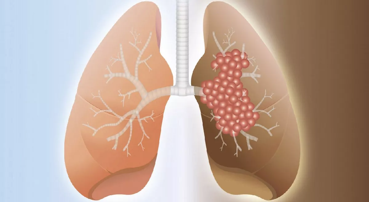 pulmonary fibrosis.jpg