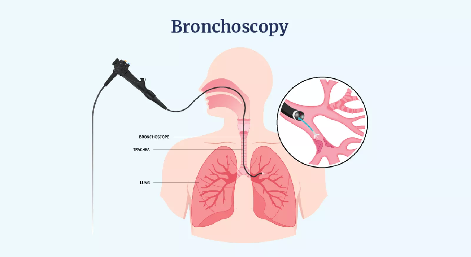 Bronchoscopy