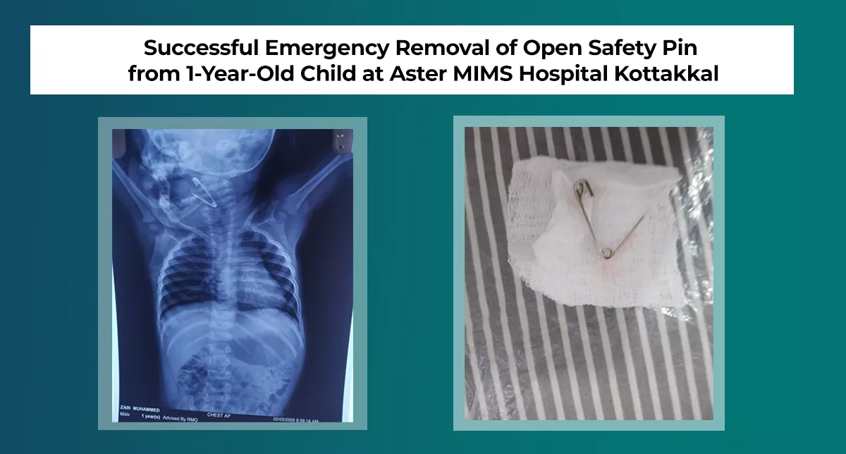 Successful Emergency Removal of Open Safety Pin from 1-Year-Old Child at Aster MIMS Hospital