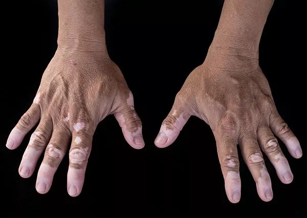 Vitiligo: What You Should Know | Aster Hospital Blogs