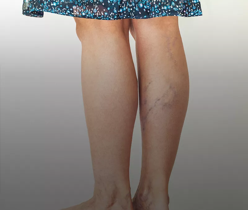 Embracing Freedom from Varicose Veins - Aster Medcity Blog