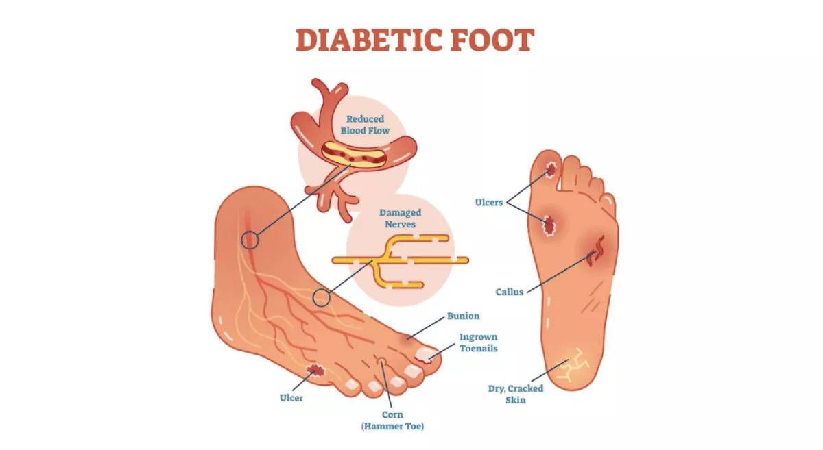 Time To Treat Your Diabetic Foot Pain And Ulcers