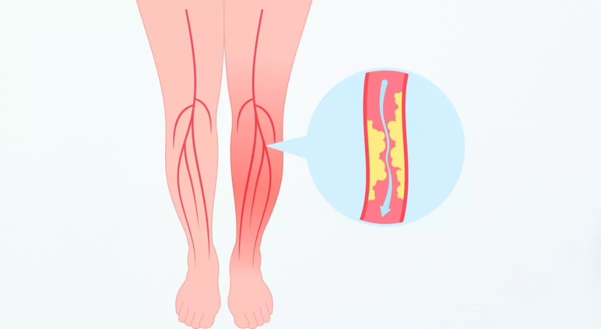 What causes Peripheral Vascular Disease in Diabetics?