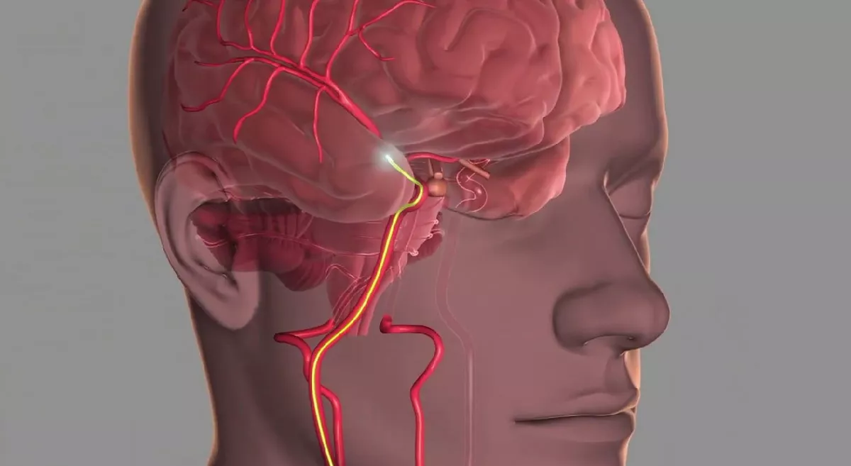 mechanical thrombectomy