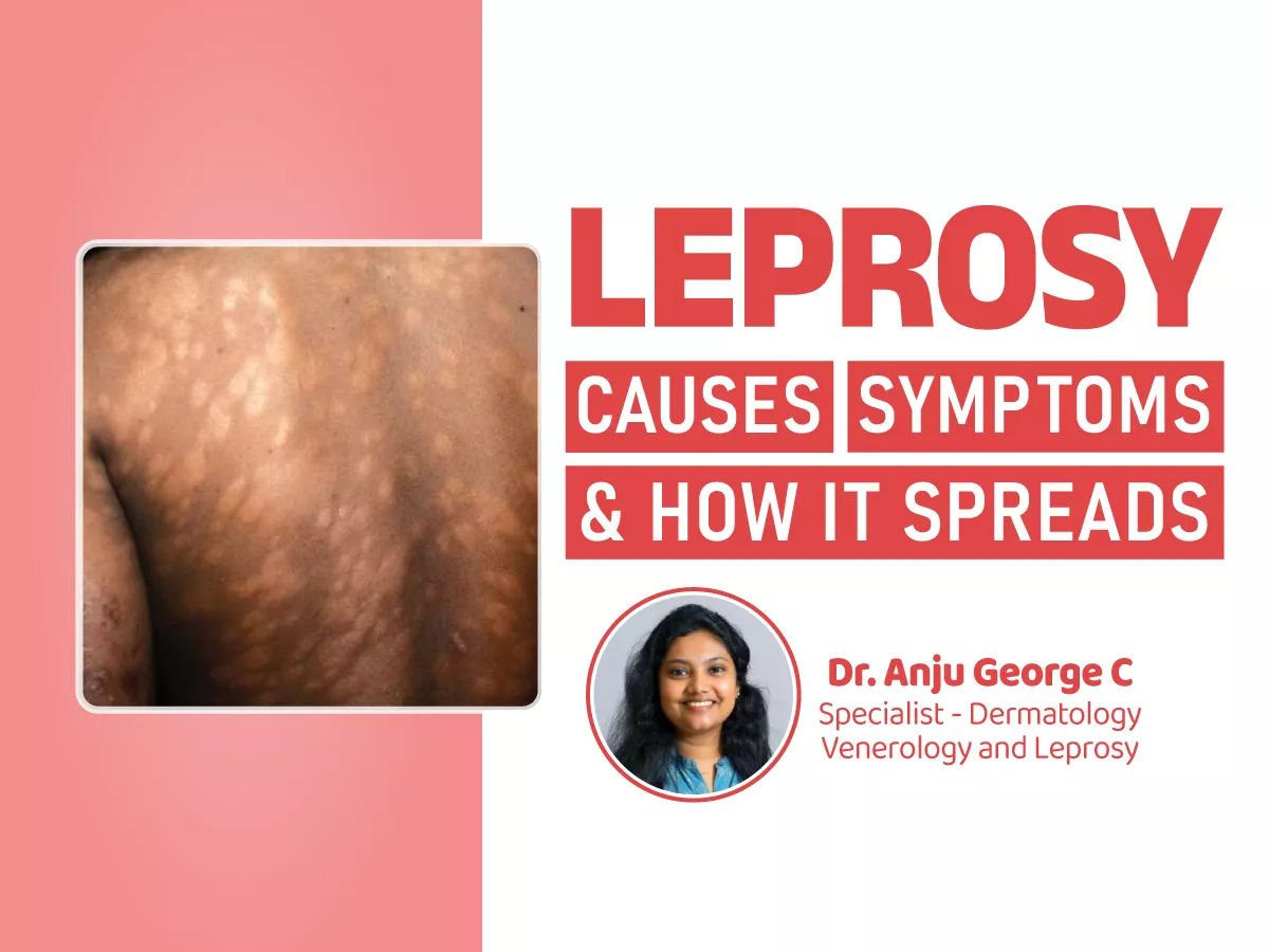 Understanding Leprosy: Causes, Symptoms, and How It Spreads