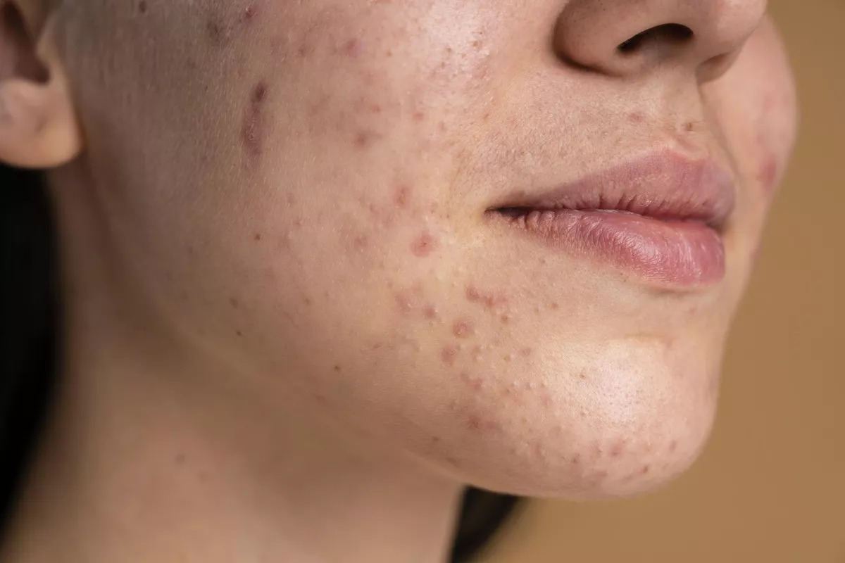 acne scars