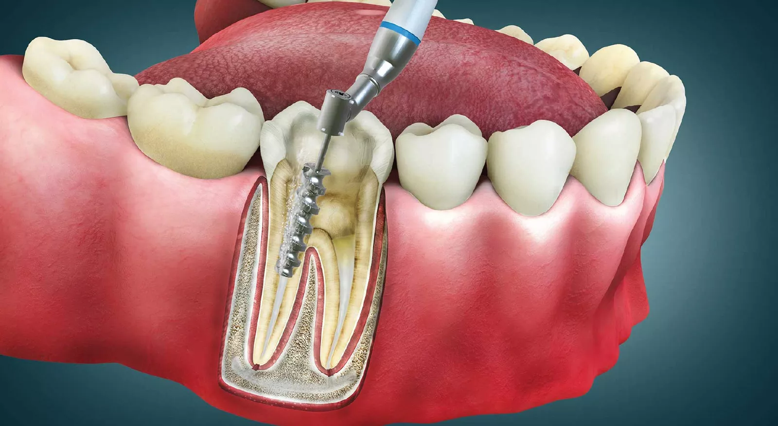 Root Canal Treatment