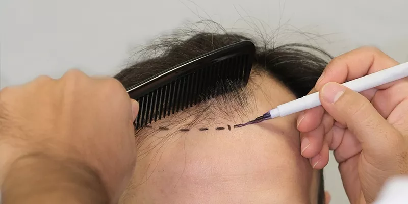 Hair Transplant