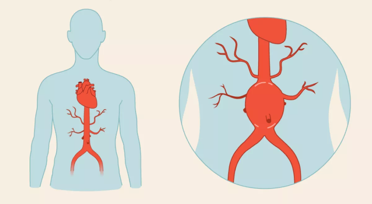 Understanding-Abdominal-Aortic-Aneurysms-(AAA)