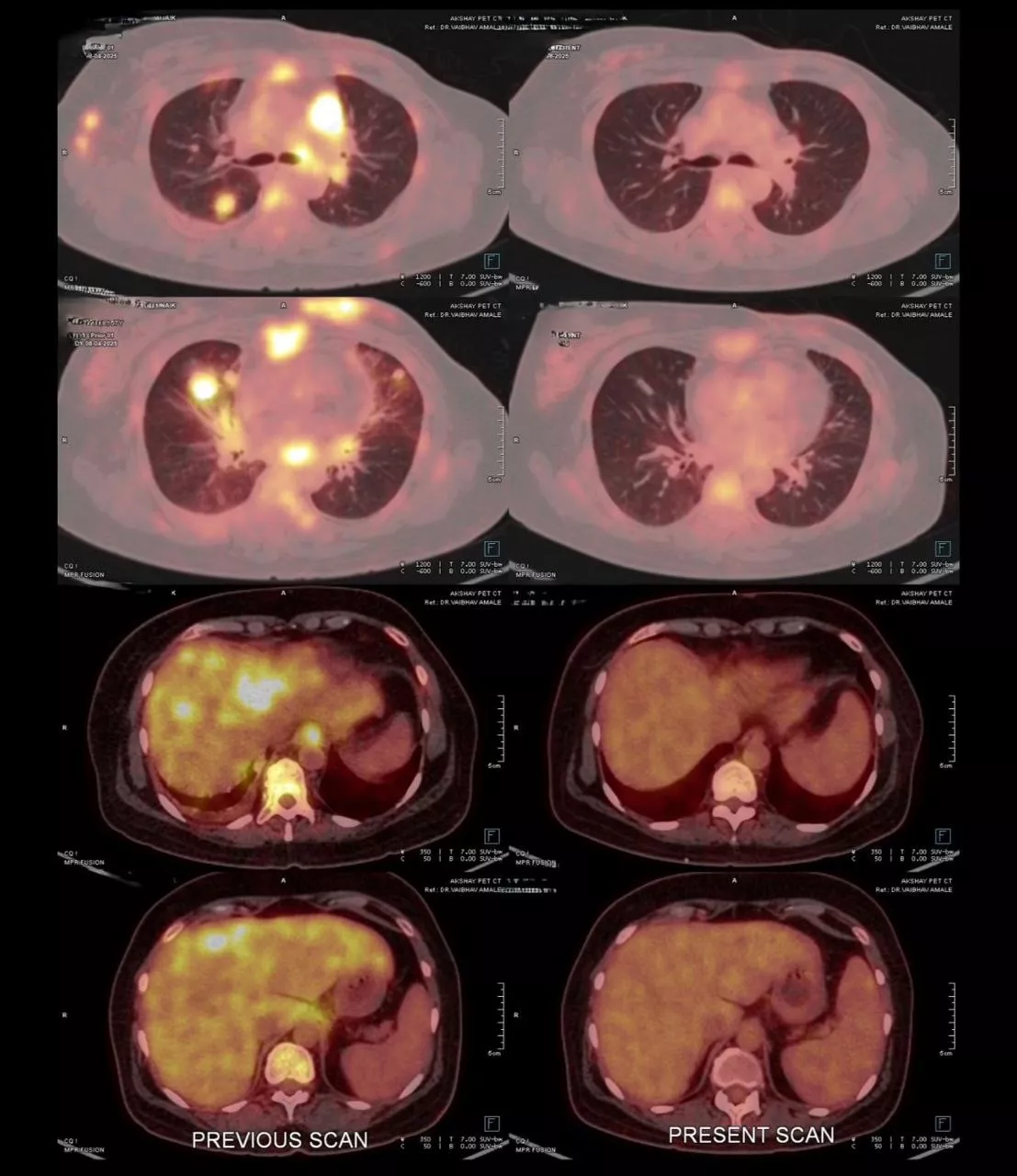Antibody drug conjugates 1